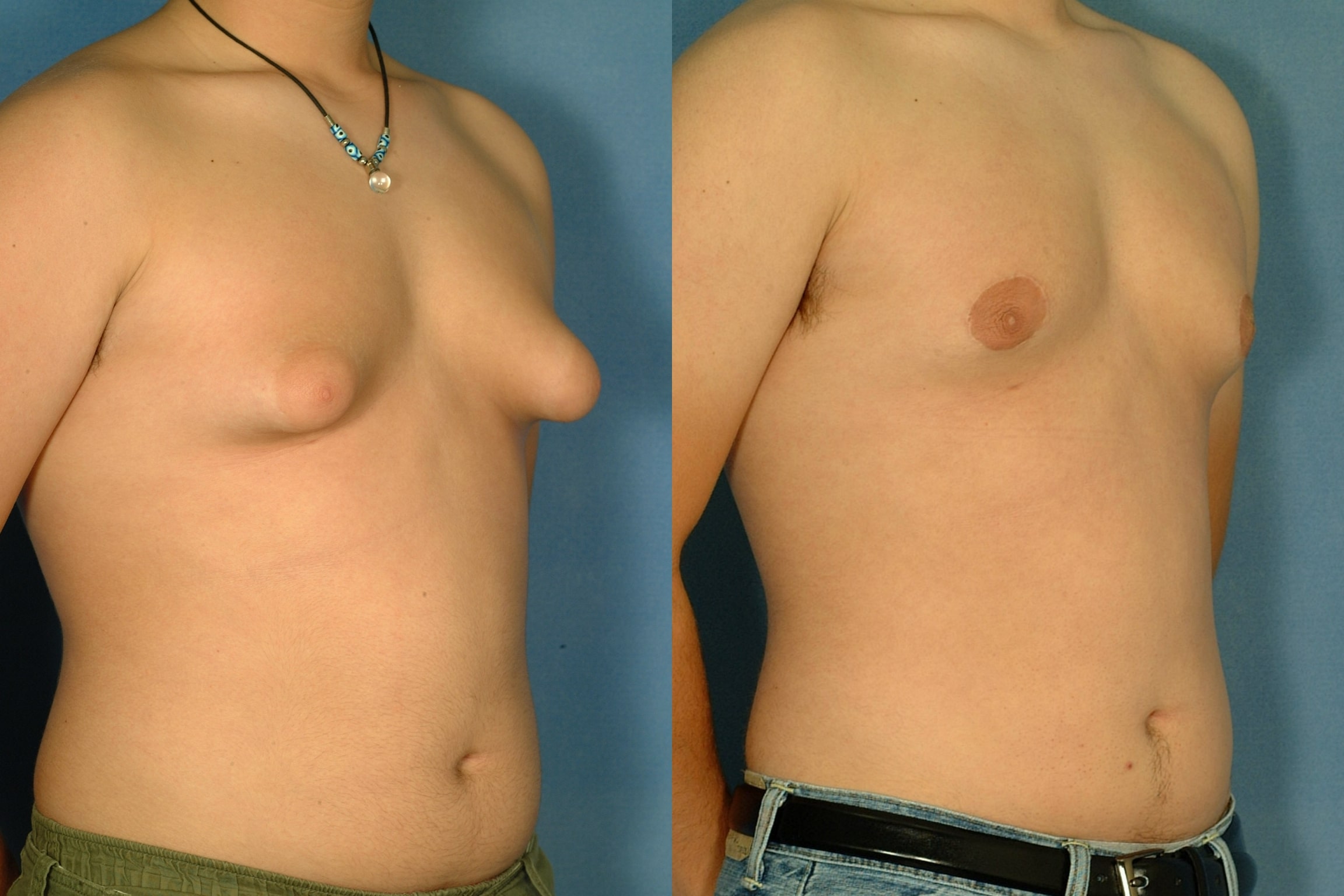 increase in the amount of breast gland tissue in mens