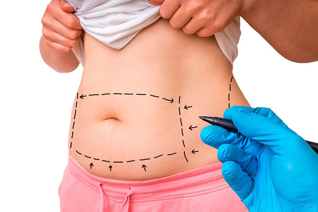 marking on stomach for Liposuction surgery